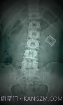 X射线扫描器胃截图3 X射线扫描器胃截图3